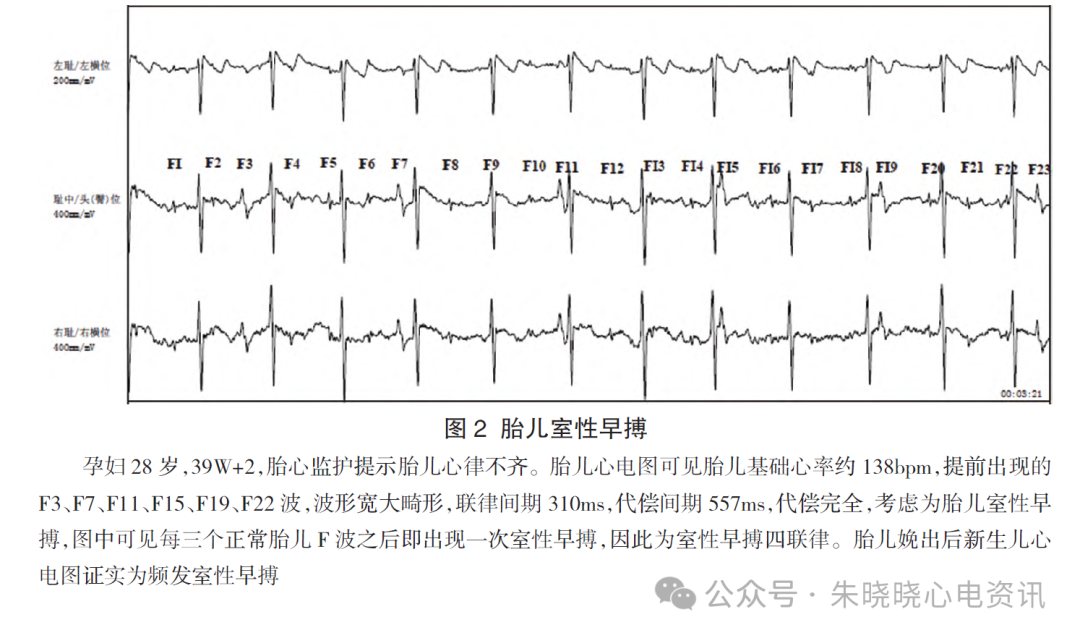 胎儿心电图是什么意思胎儿心电图精要_https://www.jmylbn.com_新闻资讯_第5张