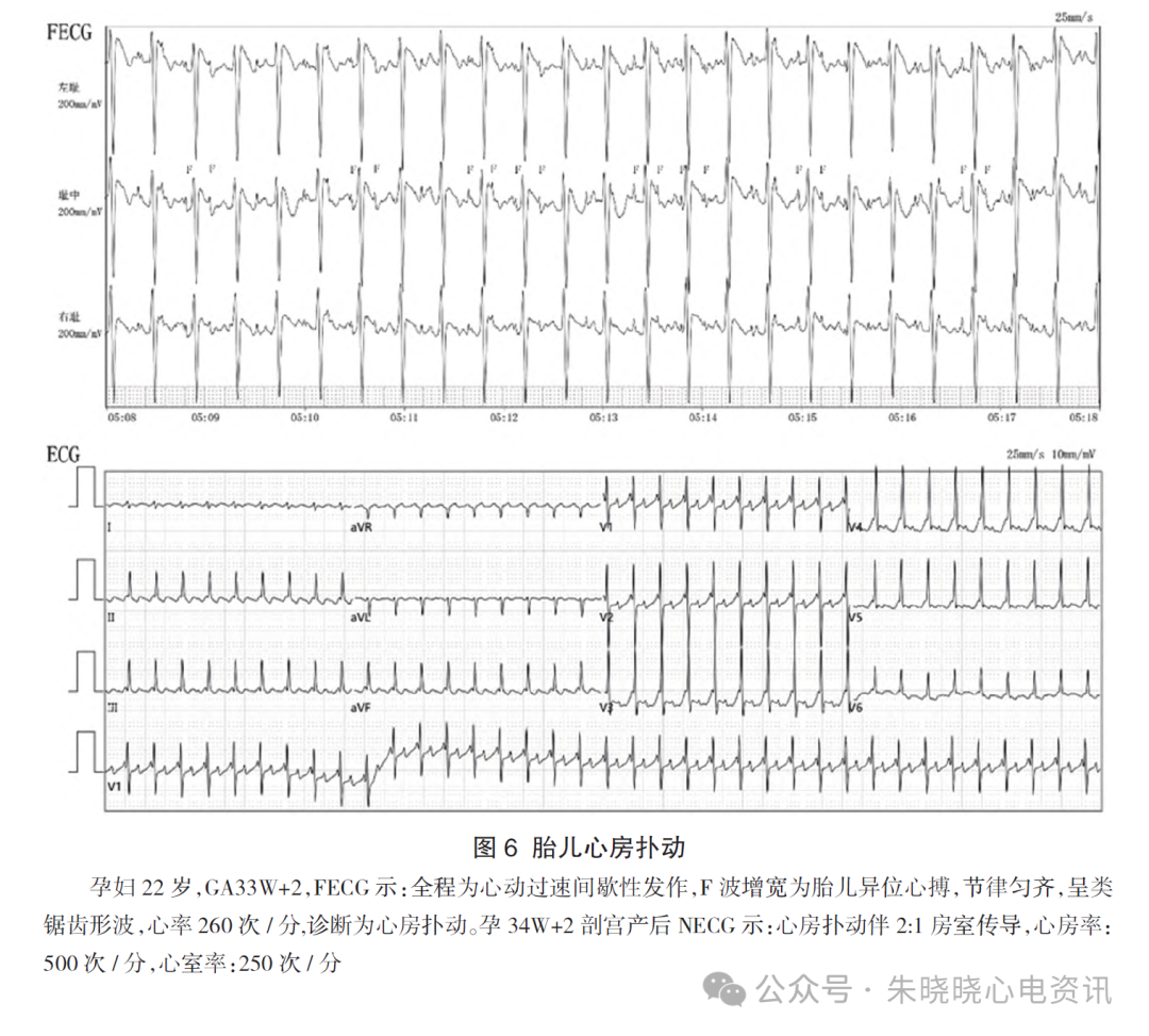 胎儿心电图是什么意思胎儿心电图精要_https://www.jmylbn.com_新闻资讯_第9张
