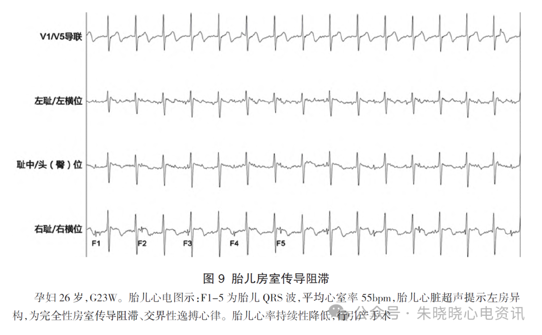 胎儿心电图是什么意思胎儿心电图精要_https://www.jmylbn.com_新闻资讯_第12张