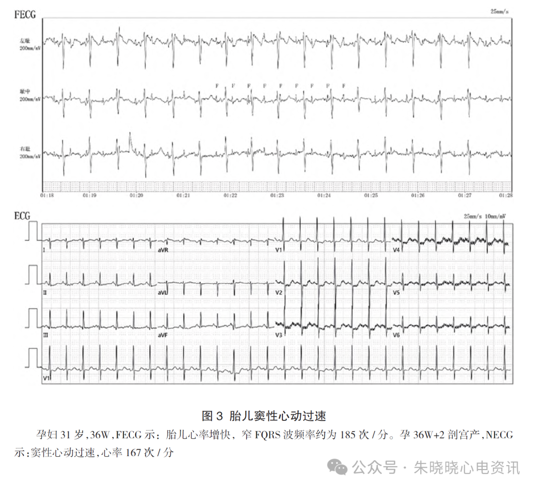 胎儿心电图是什么意思胎儿心电图精要_https://www.jmylbn.com_新闻资讯_第6张