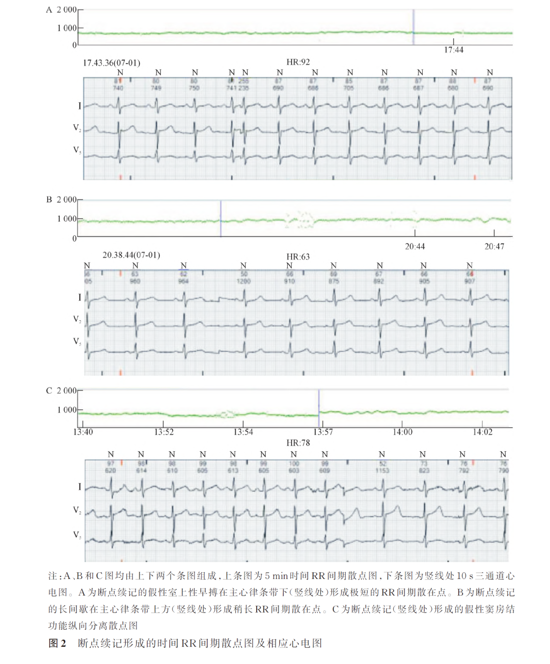 动态心电图怎么更换电池断点续记的动态心电图伪差特点及原因探讨_https://www.jmylbn.com_新闻资讯_第4张