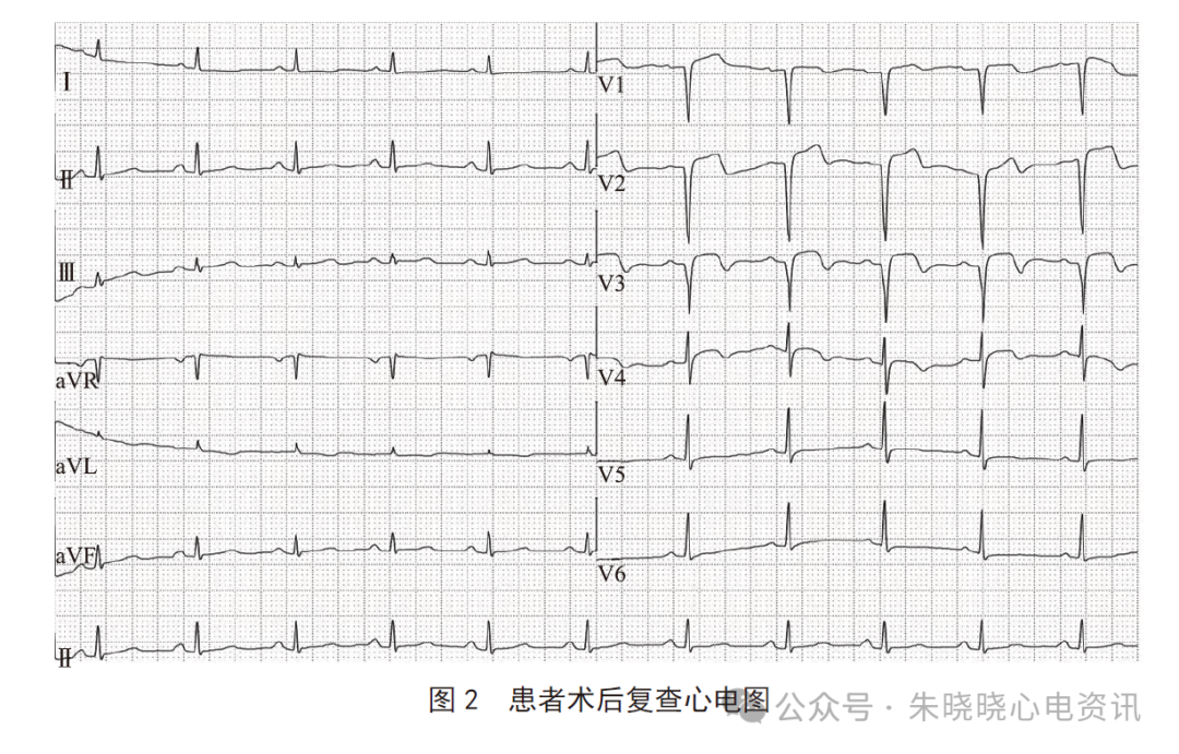应用拇指法则判断不典型急性冠脉综合征心电图改变