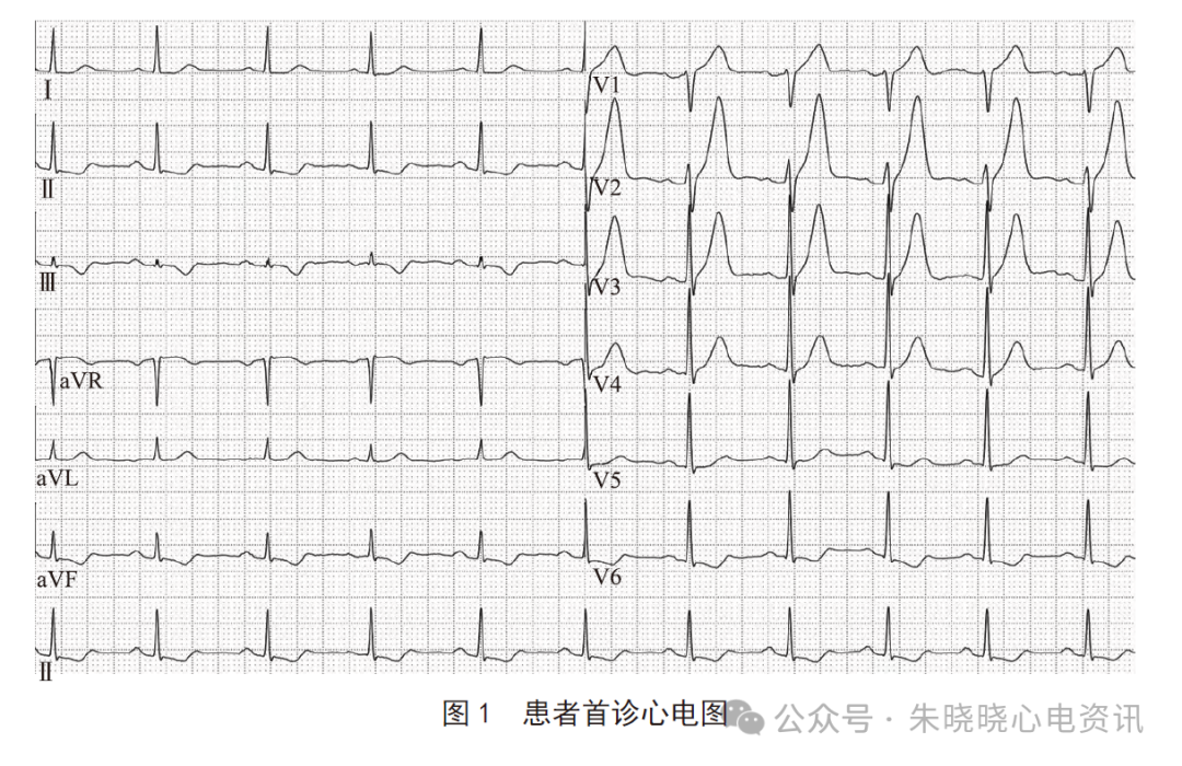 应用拇指法则判断不典型急性冠脉综合征心电图改变