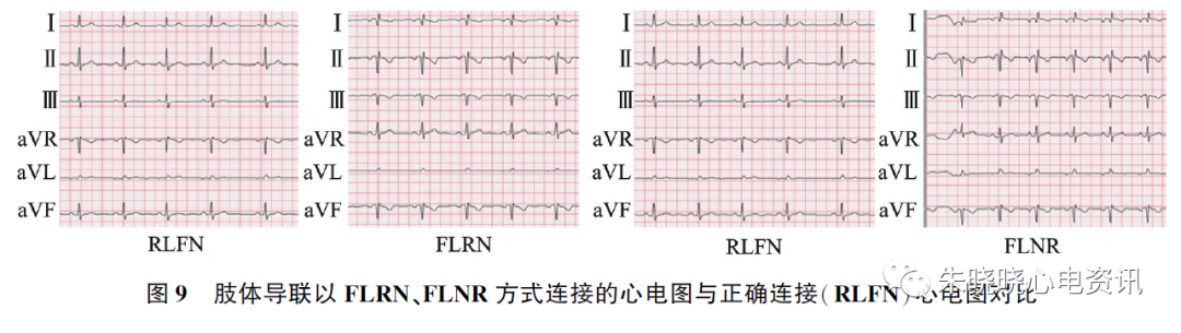 心电图怎么切换导联23种肢体导联错接心电图特点_https://www.jmylbn.com_新闻资讯_第13张