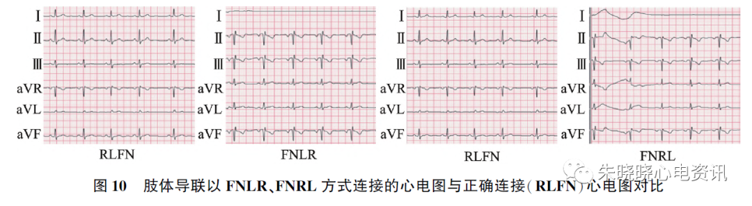 心电图怎么切换导联23种肢体导联错接心电图特点_https://www.jmylbn.com_新闻资讯_第15张
