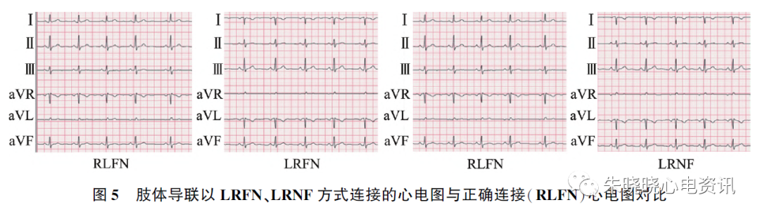 心电图怎么切换导联23种肢体导联错接心电图特点_https://www.jmylbn.com_新闻资讯_第5张