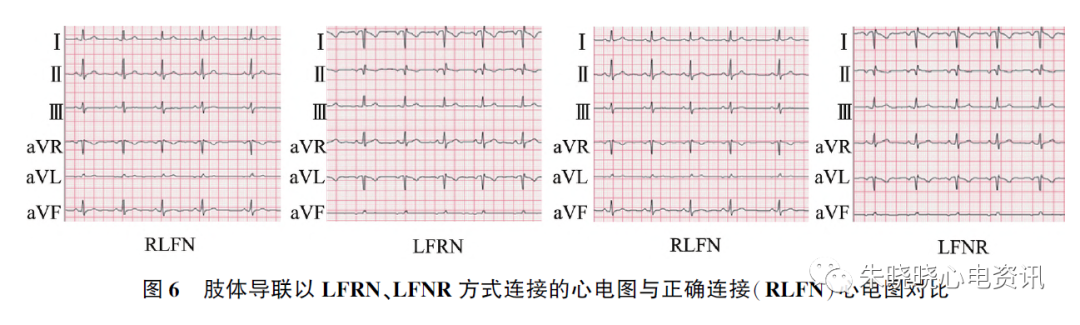 心电图怎么切换导联23种肢体导联错接心电图特点_https://www.jmylbn.com_新闻资讯_第7张