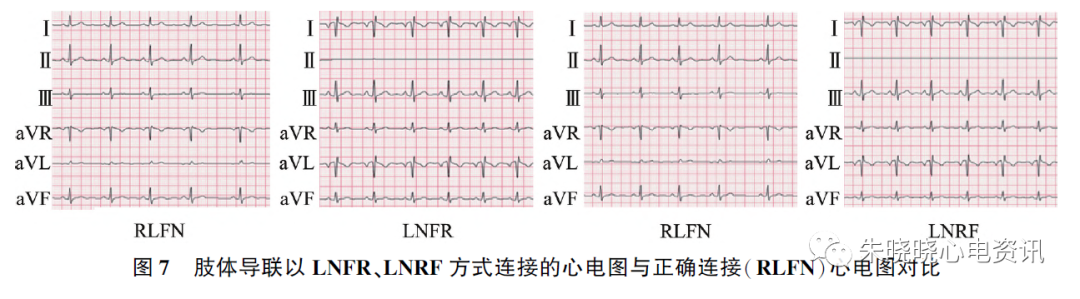 心电图怎么切换导联23种肢体导联错接心电图特点_https://www.jmylbn.com_新闻资讯_第9张