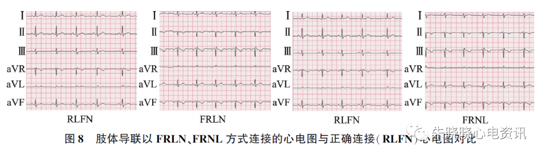 心电图怎么切换导联23种肢体导联错接心电图特点_https://www.jmylbn.com_新闻资讯_第11张