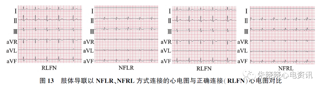 心电图怎么切换导联23种肢体导联错接心电图特点_https://www.jmylbn.com_新闻资讯_第21张