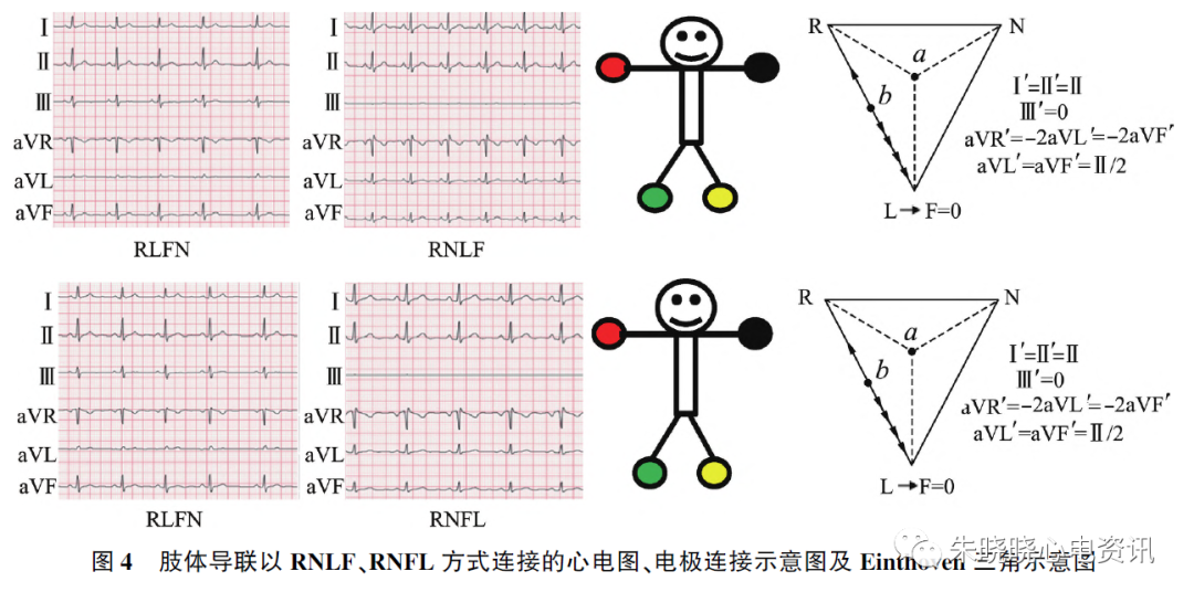 心电图怎么切换导联23种肢体导联错接心电图特点_https://www.jmylbn.com_新闻资讯_第3张