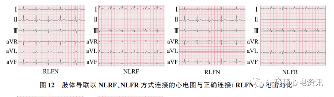 心电图怎么切换导联23种肢体导联错接心电图特点_https://www.jmylbn.com_新闻资讯_第19张