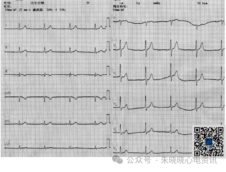 心电图器怎么用体内有两台不同类型起搏器，心电图会是什么样_https://www.jmylbn.com_新闻资讯_第2张