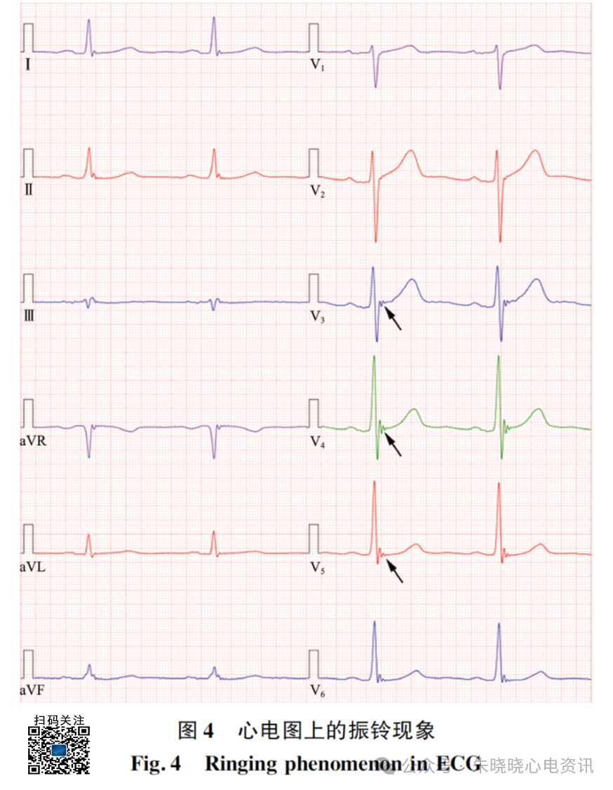 心电图滤波怎么选择振铃现象对心电图分析和诊断的影响_https://www.jmylbn.com_新闻资讯_第6张