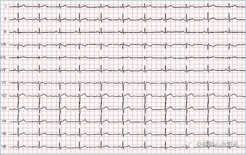 心电图滤波怎么选择【心电国际指南2009】第一部分：心电图及技术（2）_https://www.jmylbn.com_新闻资讯_第21张