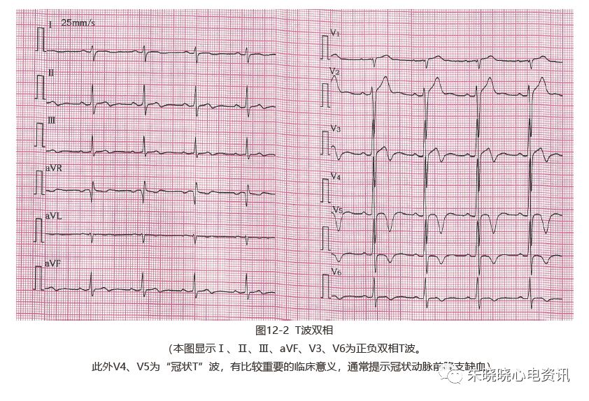 为什么选择双相波【临床实用心电图入门】 第十二讲：T波改变与心肌缺血_https://www.jmylbn.com_新闻资讯_第4张