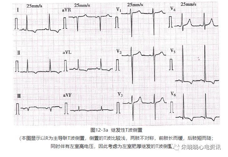 为什么选择双相波【临床实用心电图入门】 第十二讲：T波改变与心肌缺血_https://www.jmylbn.com_新闻资讯_第5张