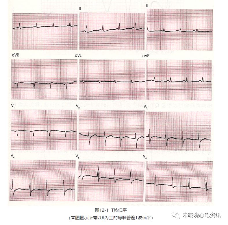为什么选择双相波【临床实用心电图入门】 第十二讲：T波改变与心肌缺血_https://www.jmylbn.com_新闻资讯_第3张