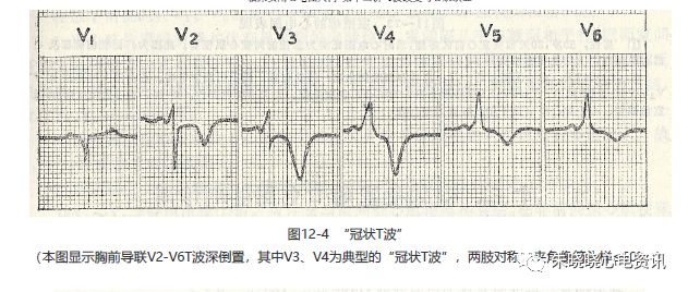 为什么选择双相波【临床实用心电图入门】 第十二讲：T波改变与心肌缺血_https://www.jmylbn.com_新闻资讯_第8张