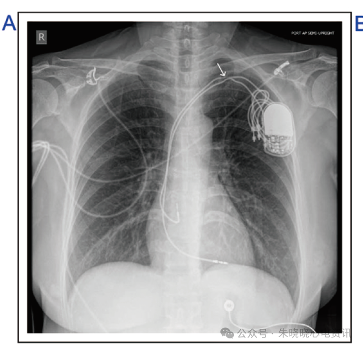 为什么双极不起博锁骨下挤压综合征_https://www.jmylbn.com_新闻资讯_第3张