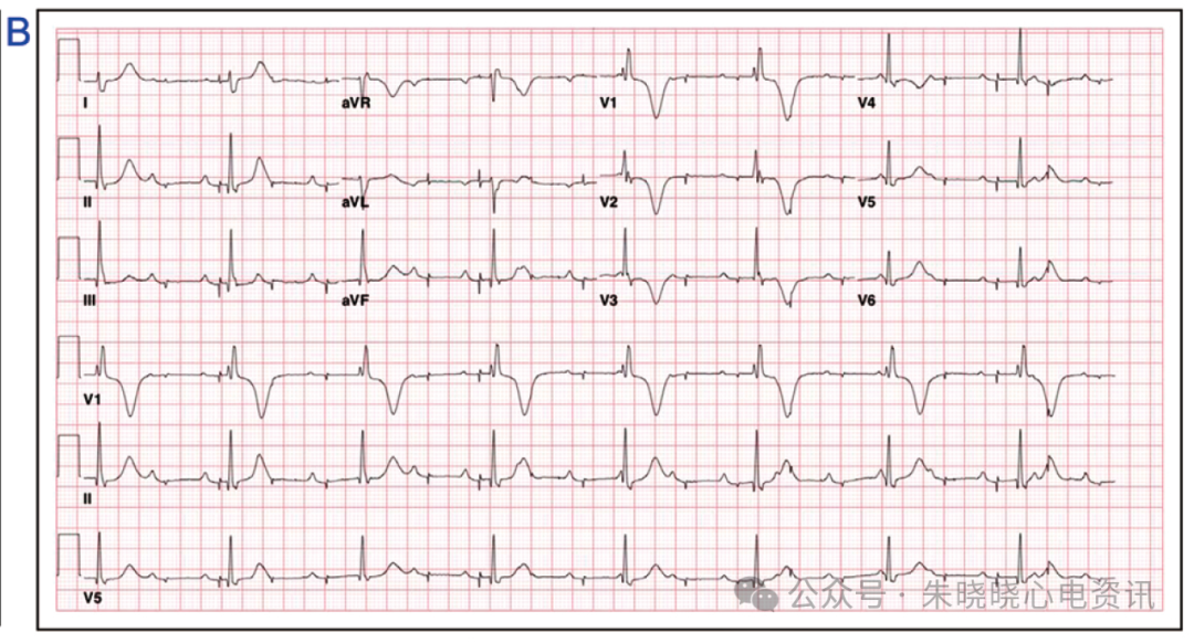 为什么双极不起博锁骨下挤压综合征_https://www.jmylbn.com_新闻资讯_第4张