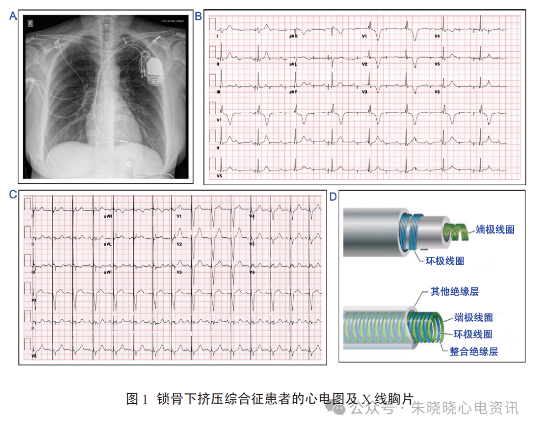 为什么双极不起博锁骨下挤压综合征_https://www.jmylbn.com_新闻资讯_第5张