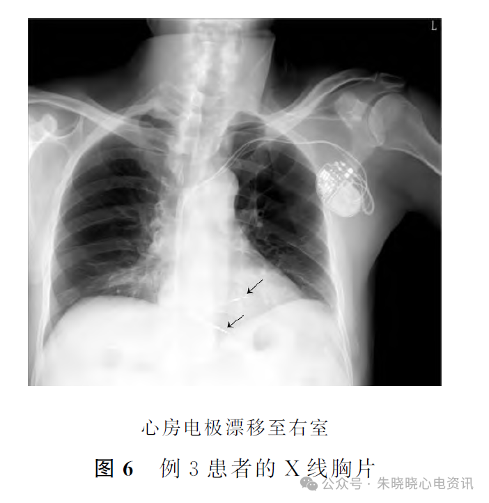 心电图电机脱落怎么回事心房电极漂移引发少见的心电图改变_https://www.jmylbn.com_新闻资讯_第8张
