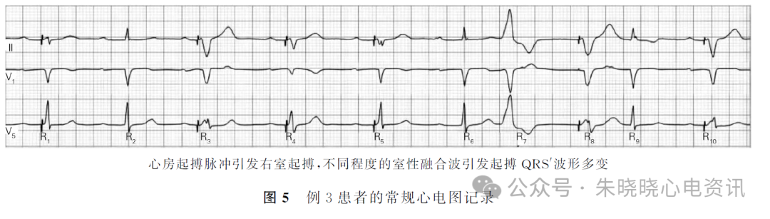 心电图电机脱落怎么回事心房电极漂移引发少见的心电图改变_https://www.jmylbn.com_新闻资讯_第7张