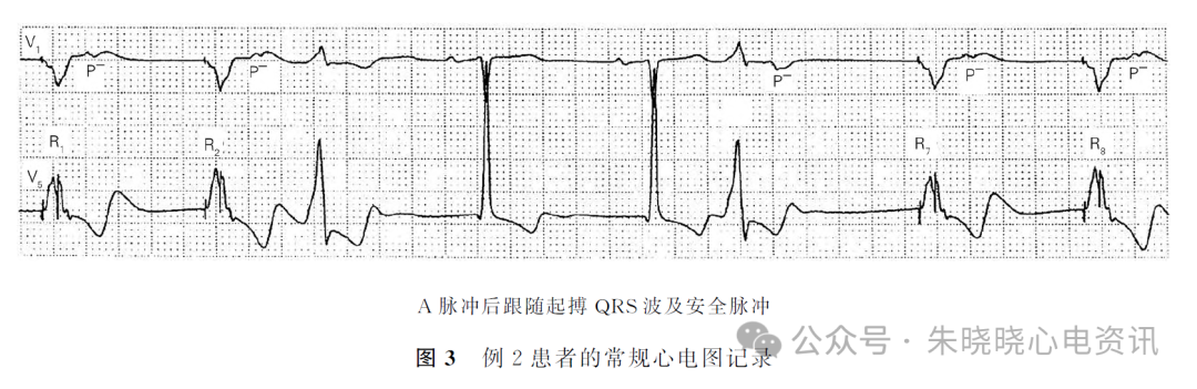 心电图电机脱落怎么回事心房电极漂移引发少见的心电图改变_https://www.jmylbn.com_新闻资讯_第5张
