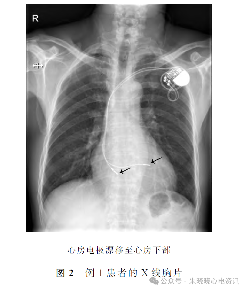 心电图电机脱落怎么回事心房电极漂移引发少见的心电图改变_https://www.jmylbn.com_新闻资讯_第4张