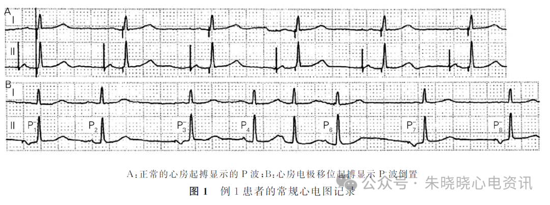 心电图电机脱落怎么回事心房电极漂移引发少见的心电图改变_https://www.jmylbn.com_新闻资讯_第3张