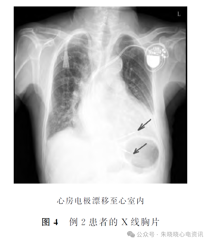 心电图电机脱落怎么回事心房电极漂移引发少见的心电图改变_https://www.jmylbn.com_新闻资讯_第6张