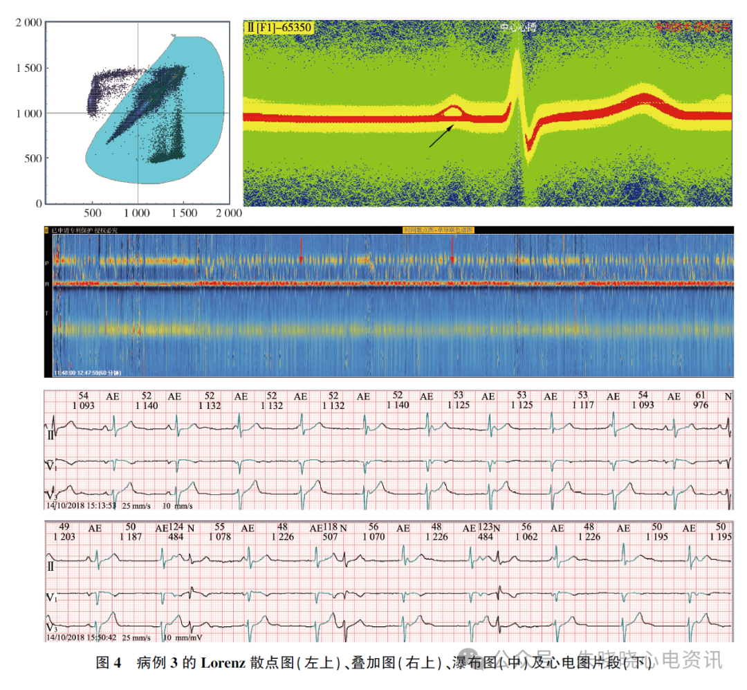 动态心电图怎么分析应用叠加图快速分析动态心电图_https://www.jmylbn.com_新闻资讯_第6张