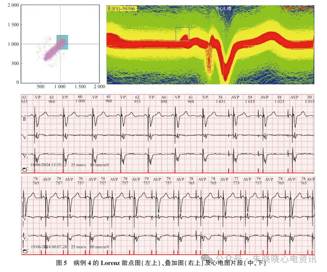 动态心电图怎么分析应用叠加图快速分析动态心电图_https://www.jmylbn.com_新闻资讯_第7张