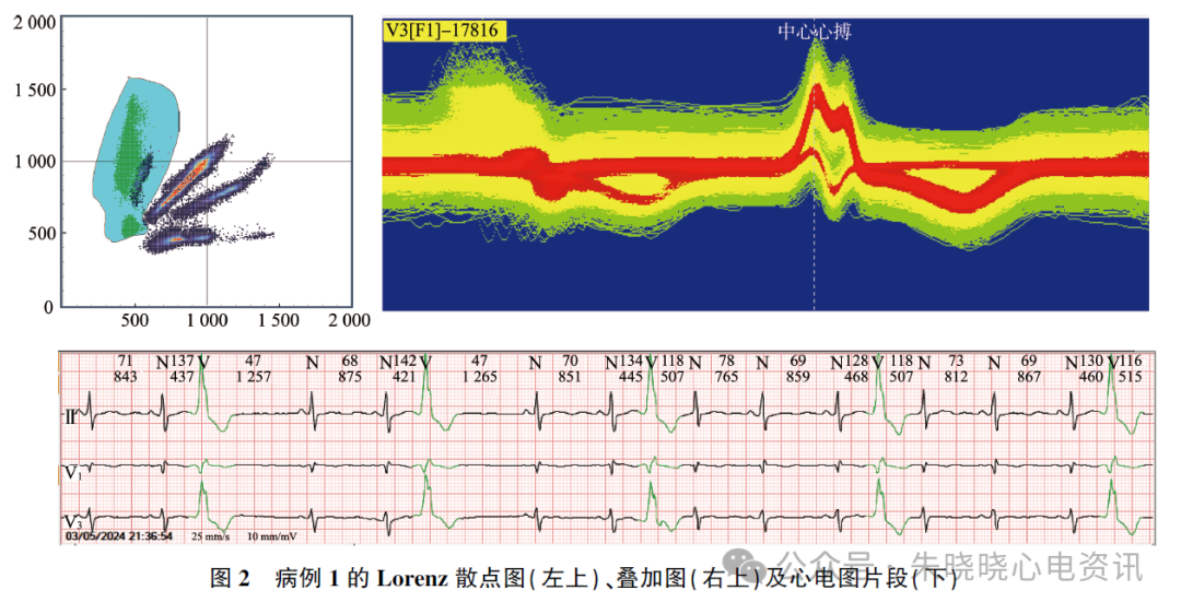 动态心电图怎么分析应用叠加图快速分析动态心电图_https://www.jmylbn.com_新闻资讯_第4张