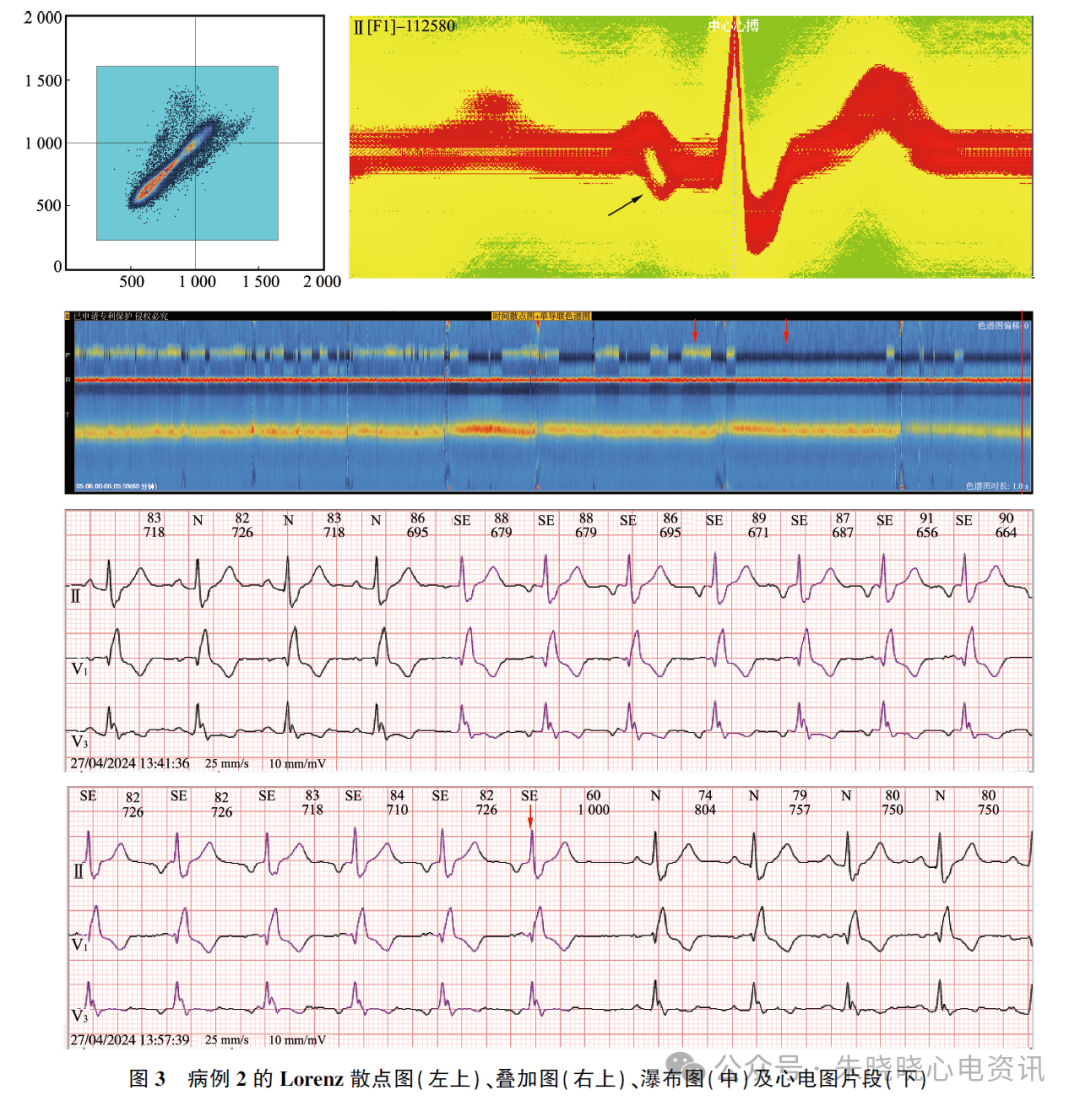 动态心电图怎么分析应用叠加图快速分析动态心电图_https://www.jmylbn.com_新闻资讯_第5张