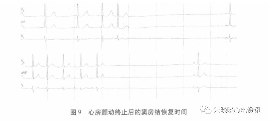 holter电极怎么贴动态心电图的规范化_https://www.jmylbn.com_新闻资讯_第20张