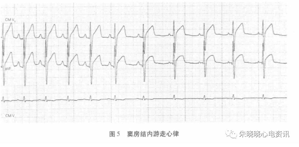 holter电极怎么贴动态心电图的规范化_https://www.jmylbn.com_新闻资讯_第16张