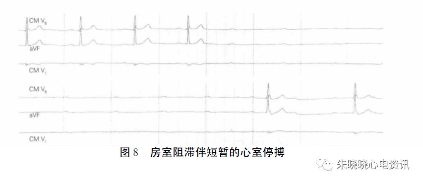 holter电极怎么贴动态心电图的规范化_https://www.jmylbn.com_新闻资讯_第19张