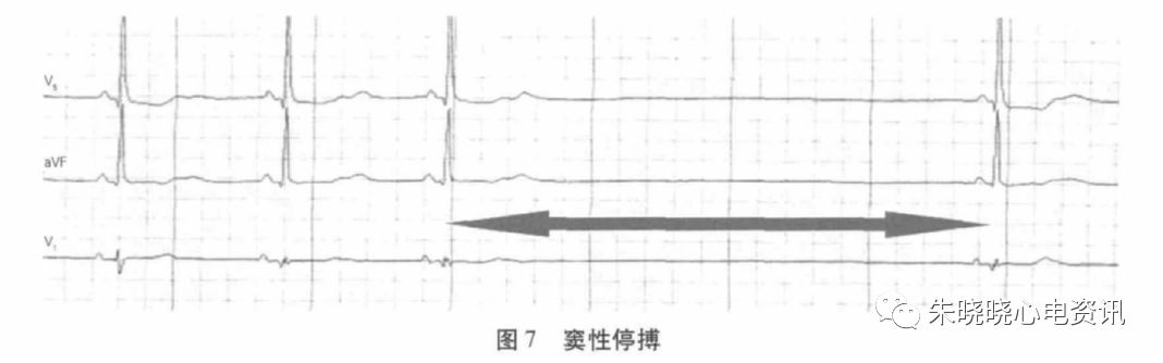 holter电极怎么贴动态心电图的规范化_https://www.jmylbn.com_新闻资讯_第18张