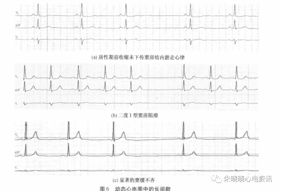 holter电极怎么贴动态心电图的规范化_https://www.jmylbn.com_新闻资讯_第17张