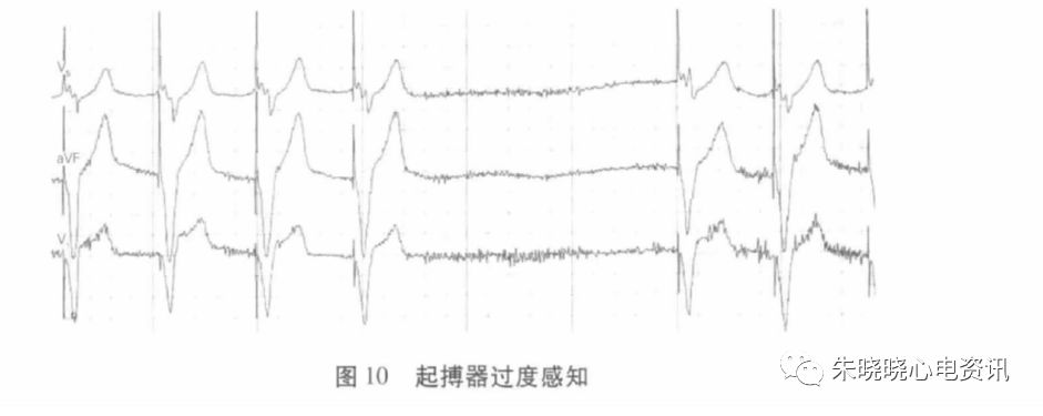 holter电极怎么贴动态心电图的规范化_https://www.jmylbn.com_新闻资讯_第21张