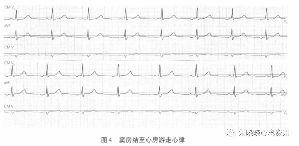 holter电极怎么贴动态心电图的规范化_https://www.jmylbn.com_新闻资讯_第15张