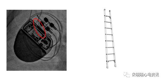 百多力起搏器怎么样通过胸片识别起搏器的简易三步法_https://www.jmylbn.com_新闻资讯_第13张