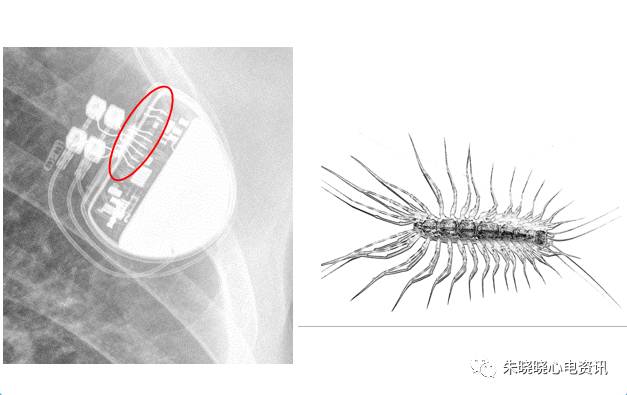 百多力起搏器怎么样“贴心”的通过胸片识别起搏器方法，让你秒懂_https://www.jmylbn.com_新闻资讯_第11张