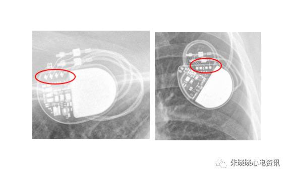 百多力起搏器怎么样通过胸片识别起搏器的简易三步法_https://www.jmylbn.com_新闻资讯_第17张