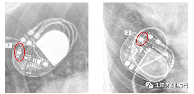 百多力起搏器怎么样“贴心”的通过胸片识别起搏器方法，让你秒懂_https://www.jmylbn.com_新闻资讯_第10张