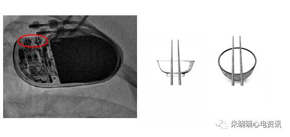百多力起搏器怎么样“贴心”的通过胸片识别起搏器方法，让你秒懂_https://www.jmylbn.com_新闻资讯_第13张