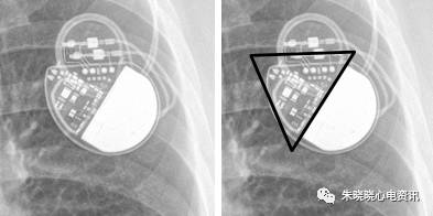 百多力起搏器怎么样通过胸片识别起搏器的简易三步法_https://www.jmylbn.com_新闻资讯_第10张
