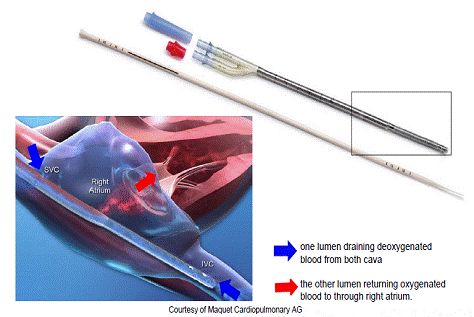 什么是气体陷闭ECMO的裝置与准备_https://www.jmylbn.com_新闻资讯_第21张